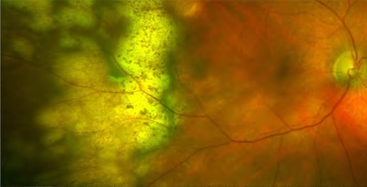 linfoma oculare cura definitiva