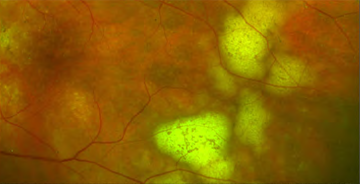 linfoma oculare centri di eccellenza a milano