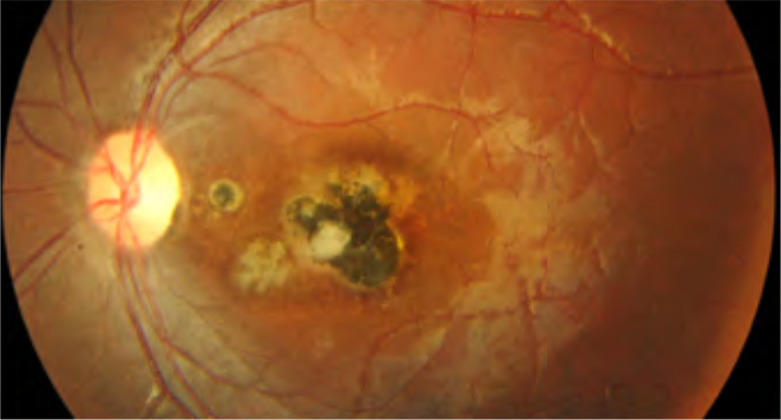 toxoplasmosi oculare centro specialistico di riferimento