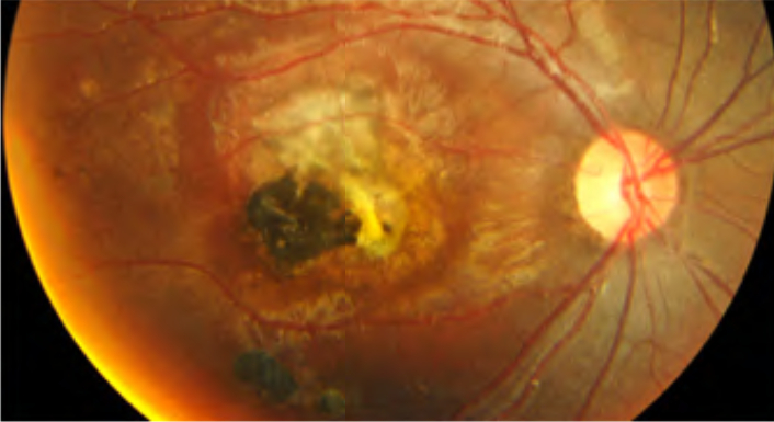 toxoplasmosi oculare diagnosi sintomi cure