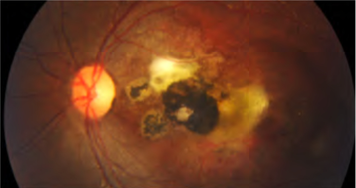 toxoplasmosi oculare centro uveiti milano
