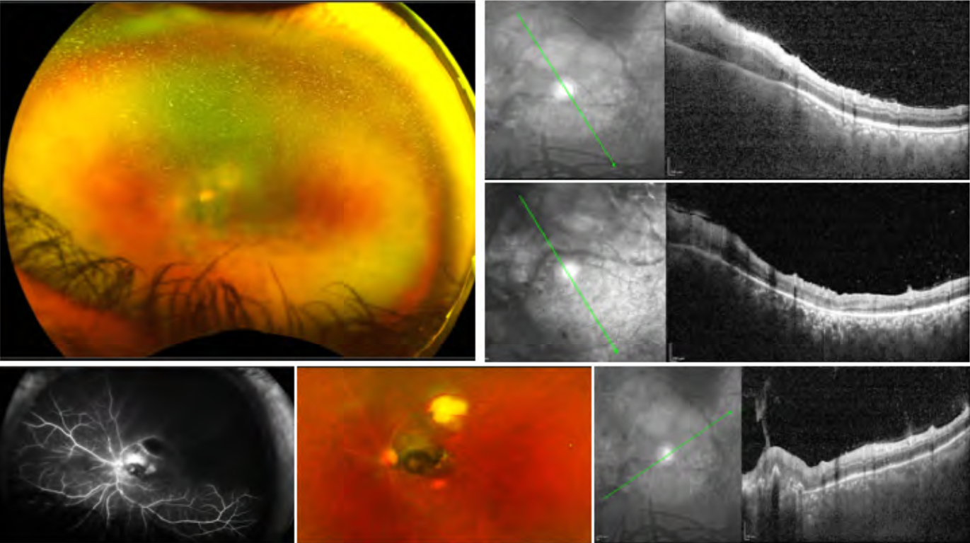 toxoplasmosi oculare centri di eccellenza a milano