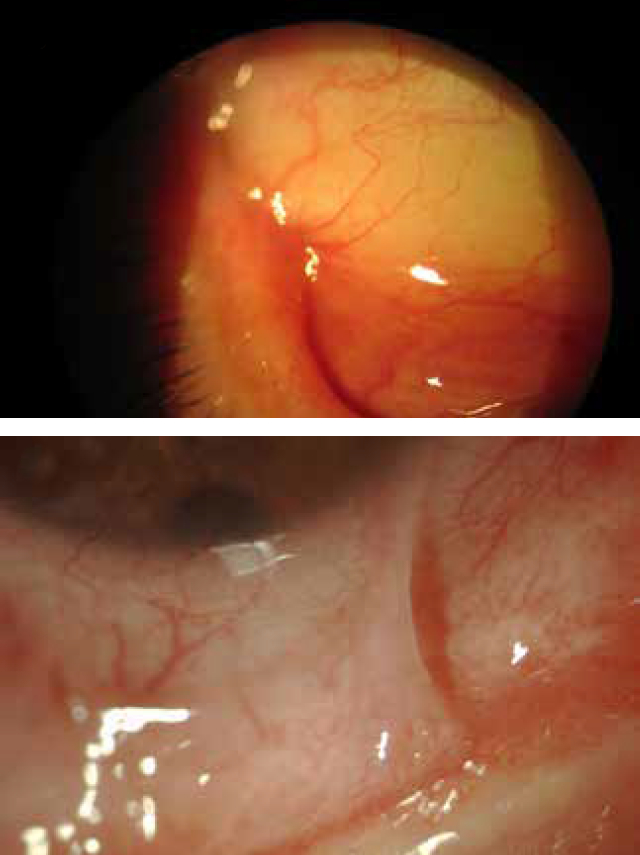 pemfigoide cicatriziale oculare cura definitiva